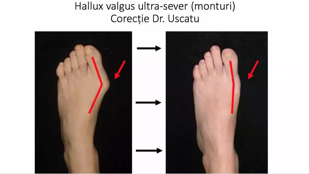 Cumpărați Valgus 2 in 1 în Tulcea – Soluționați rapid problemele cu degetele de la picioare