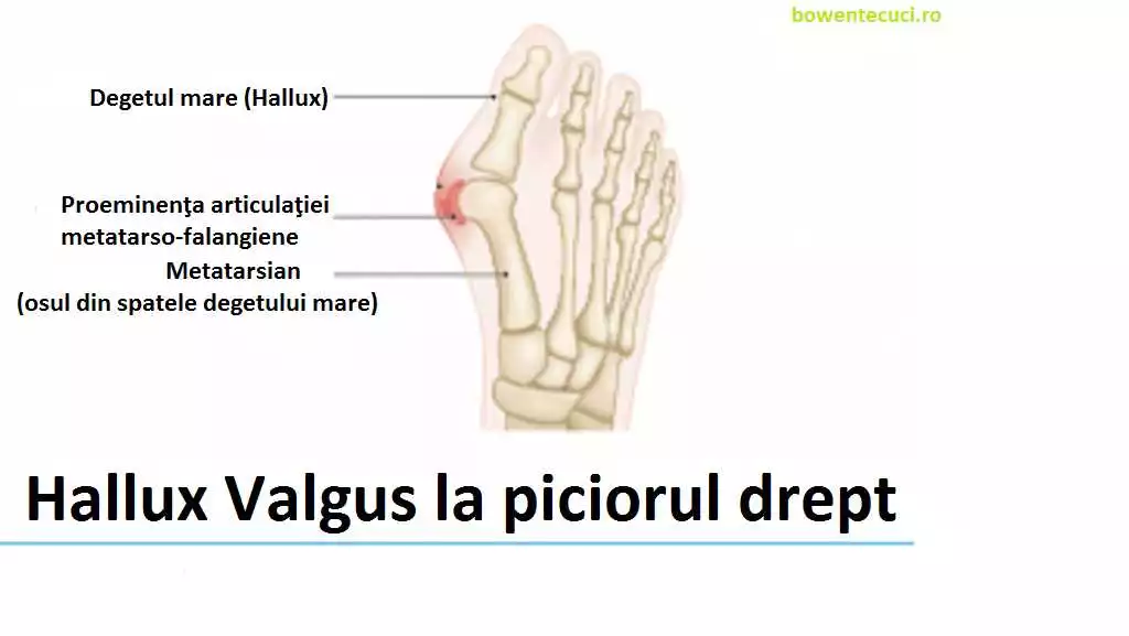 Valgus 2 in 1 – Tratament eficient și confortabil pentru deformarea valgus a degetului mare