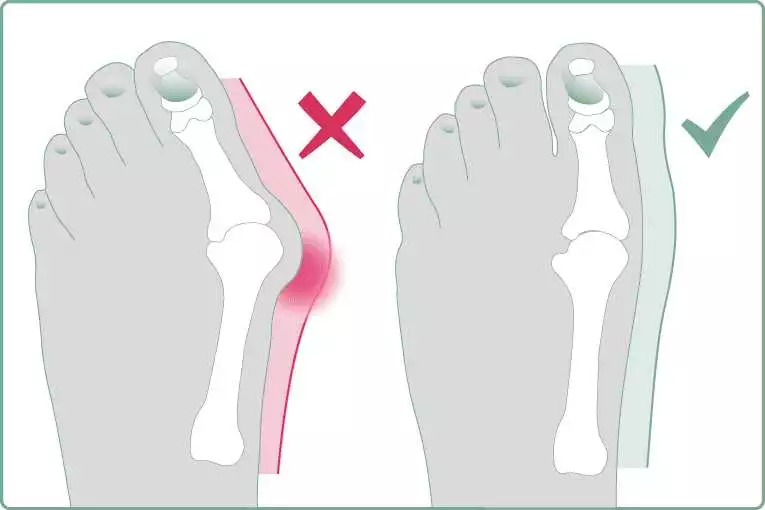 Valgus 2 In 1 - Prevenția Și Tratamentul Picioarelor Plate